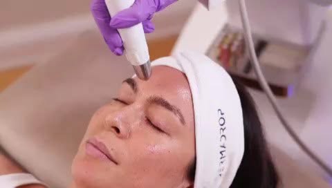 Microneedling-Behandlung im Gesicht mit Dermadrop-Stirnband